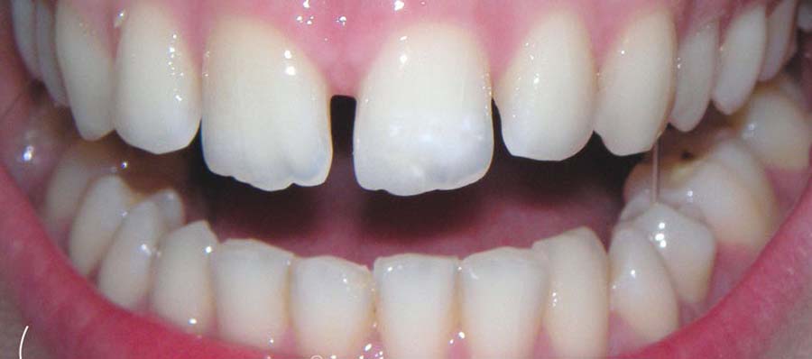Bild2 zeigt Zähne vor der Korrektur mit der Harmonieschiene