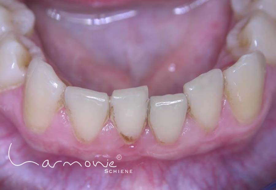 Bild zeigt Zähne vor der Korrektur mit der Harmonieschiene