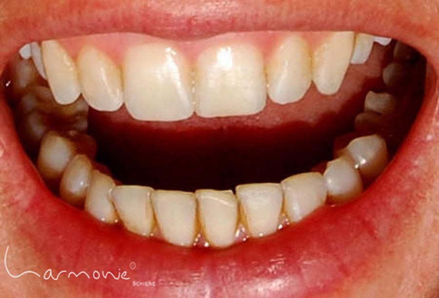 Bild3 zeigt Zähne nach der Korrektur mit der Harmonieschiene