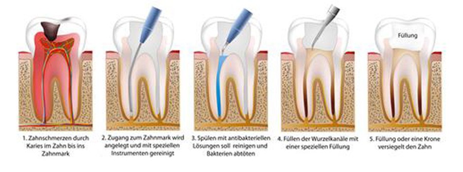 Das Bild zeigt wie eine Endodontie abläuft